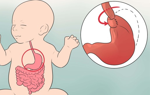 what is reflux in infants