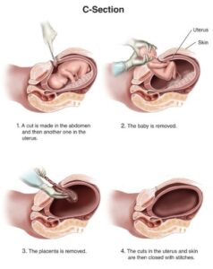 c section birth